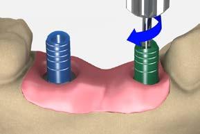 screw-retained restorations screw-retained bridge using custom-cast abutments The custom castable abutment, non-hexed (UCLA) offers the clinician the option of making a custom bridge that is