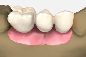 screw-retained restorations screw-retained bridge using custom-cast abutments 9 Lab step - Apply the porcelain Apply opaque and porcelain to the metal framework and complete according to routine