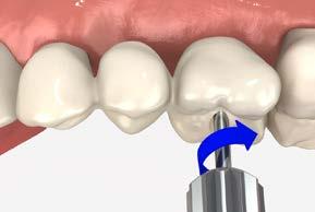 Implant analogs may be used to protect the connection during polishing. Secure the finished bridge onto the analogs on the working model and send to clinician for patient delivery.