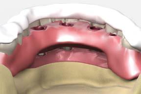 It may be necessary to make adjustments and new inter-occlusal records for a new try-in. Remove the trial hybrid denture and replace the healing caps using an.050 (1.25mm) hex driver.