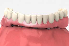 send to lab trial hybrid denture mounted on working model new inter-occlusal records, if necessary 11 Lab step - Form a matrix Index the working model with circular grooves or notches to allow for