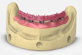 full-arch restorations Multi-unit abutment hybrid or fixed-detachable screw-retained restoration 12 Lab step - Place the copings Place the gold custom castable copings for the Multiunit abutment on