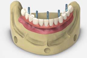 full-arch restorations Multi-unit abutment hybrid or fixed-detachable screw-retained restoration 17 Lab step - Wax set-up Set-up the denture teeth in wax following conventional denture procedures and