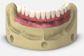 send to clinician hybrid frame with teeth set up in wax regular prosthetic screws working model 18 Trial hybrid denture try-in Remove the healing caps from the Multi-unit abutments using an.050 (1.