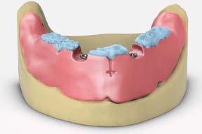 full-arch restorations Multi-unit abutment bar overdenture 7 Attach the baseplate to the working model Remove the baseplate and the bite registration from the mouth and reassemble on the working