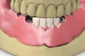 Note: If making a verification jig, refer to verification jig fabrication module. Return the case to the laboratory for the fabrication of a stabilized trial denture.