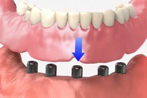 send to lab trial denture new inter-occlusal records, if necessary 10 Lab step - Form a matrix Index the working model with circular grooves or notches