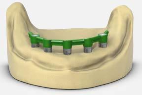 full-arch restorations Multi-unit abutment bar overdenture 12 Lab step - Wax the bar Verify attachment position, bar height and functional requirements.