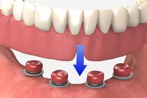 There must be no contact between the denture and the titanium caps. If the denture rests on the metal cap, excess pressure on the implant will result.