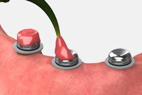 6 Apply the acrylic Use either a chairside light cure acrylic resin or a permanent self-curing acrylic to bond the denture caps to the denture.