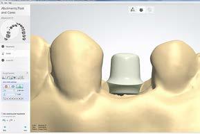 Option A - The first and most common method is to take an implant level impression, pour a stone model, place a software-dependent scan body onto the implant analog and scan the model using a 3D