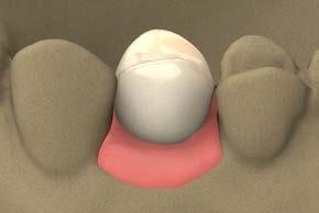 custom CAD/CAM restorations custom (CAD/CAM) prosthetics overview There are five steps to creating and delivering a custom (CAD/CAM) abutment and final restoration.