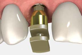 This procedure creates a model that represents the exact position of the implant, the orientation of the hex and the soft tissue profile.