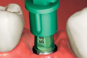 Choose the proper Simple Solutions restorative pack that is the same height and color of the Simple Solutions abutment. The height is marked for visible recognition on the flats of the abutment.