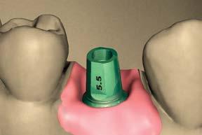 groove 8 Lab step - Create a soft tissue model Verify that the abutment replica is properly seated. Apply lubricant where the soft tissue replica material is to be applied.