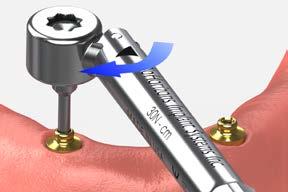 5 Make a full-arch impression Syringe a medium or heavy-bodied elastomeric impression material around the impression copings.