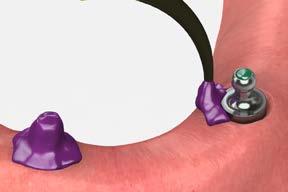 Make a denture impression to record all soft tissue contours for the new denture fabrication.