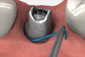 abutment selection & handling crown cementation technique Many studies have shown excess cement left in the sulcus when cementing implant-supported crowns can cause peri-implant disease, possibly