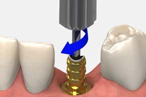 Do not modify the margin where the Laser-Lok zone is located. Laser-Lok zone Note: Replace the healing abutment immediately to prevent soft tissue collapse over the implant.