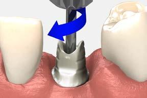 Note: Replace the healing abutment immediately to prevent soft tissue collapse over the implant.