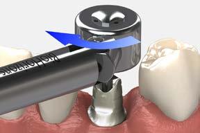 Place the modified plastic abutment and abutment screw onto the implant using an.050 (1.25mm) hex driver and hand tighten.