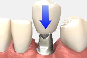 temporary restorations cement-retained crown using a PEEK temporary abutment 7 Block the screw access hole Place a resilient material of choice (gutta-percha,