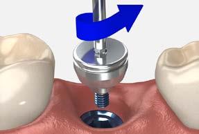 temporary restorations screw-retained crown using a PEEK temporary abutment Use this technique for the fabrication of short term (30 days), screw-retained single or multi