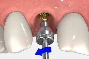 temporary restorations immediate cement-retained restorations using the two-piece custom temporary abutment The two-piece custom temporary abutment is intended for single-unit, cement-retained