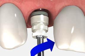 Important: For ideal results, Laser-Lok components should be used throughout the healing, temporization and final abutment phases.