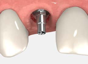 temporary restorations immediate cement-retained restorations using the Laser-Lok two-piece custom temporary abutment The following illustrates the steps necessary when making an impression for the