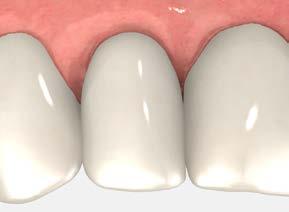 temporary restorations immediate cement-retained restorations using the Laser-Lok two-piece custom temporary abutment 11 Cement the crown Place a small amount of cement of choice around the inside