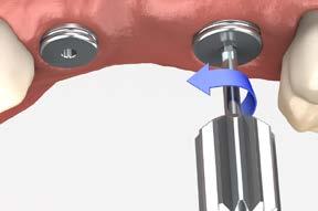 Check the occlusion and contacts. There should only be light contact in centric occlusion and no contact in lateral excursions. Modify as necessary and polish after making adjustments.