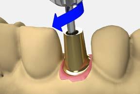 Evaluate inter-occlusal dimensions, angulations, and tissue contour. Mark the abutment for the required vertical reduction and gingival contour. Note: Allow a minimum of 1.5 2.