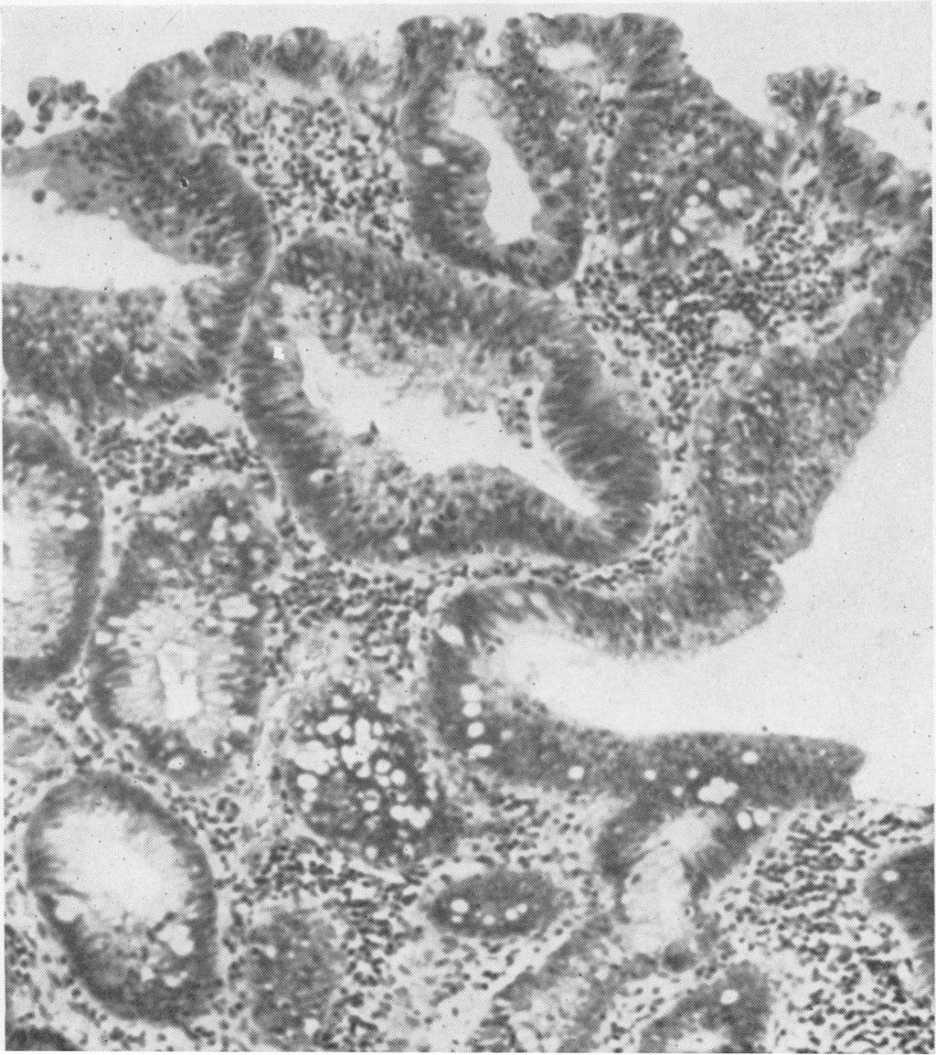 There is almost complete loss ofgoblet cell secretion; also inflammation of the lamina propria. H. & E. x 300. FIG. 7.