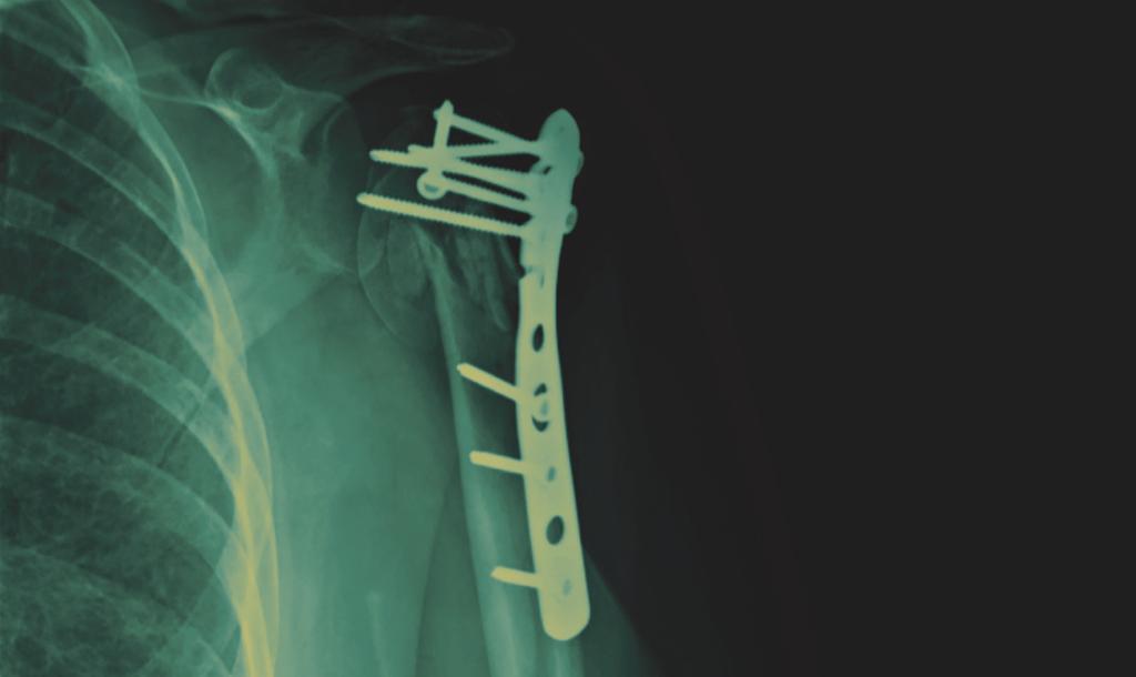 The complexity of reverse shoulder arthroplasty has increased as implant options and indications have expanded.