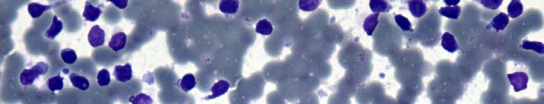 Nodular lymphocyte