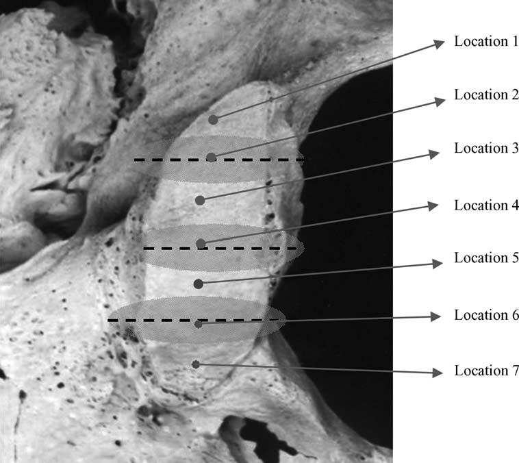 194 S. Naderi et al. / Clinical Neurology and Neurosurgery 107 (2005) 191 199 Fig. 3. The location of intracranial and extracranial orifices of hypoglossal canal. 3. Results The results obtained from the linear and angular measurements are presented in Table 3.