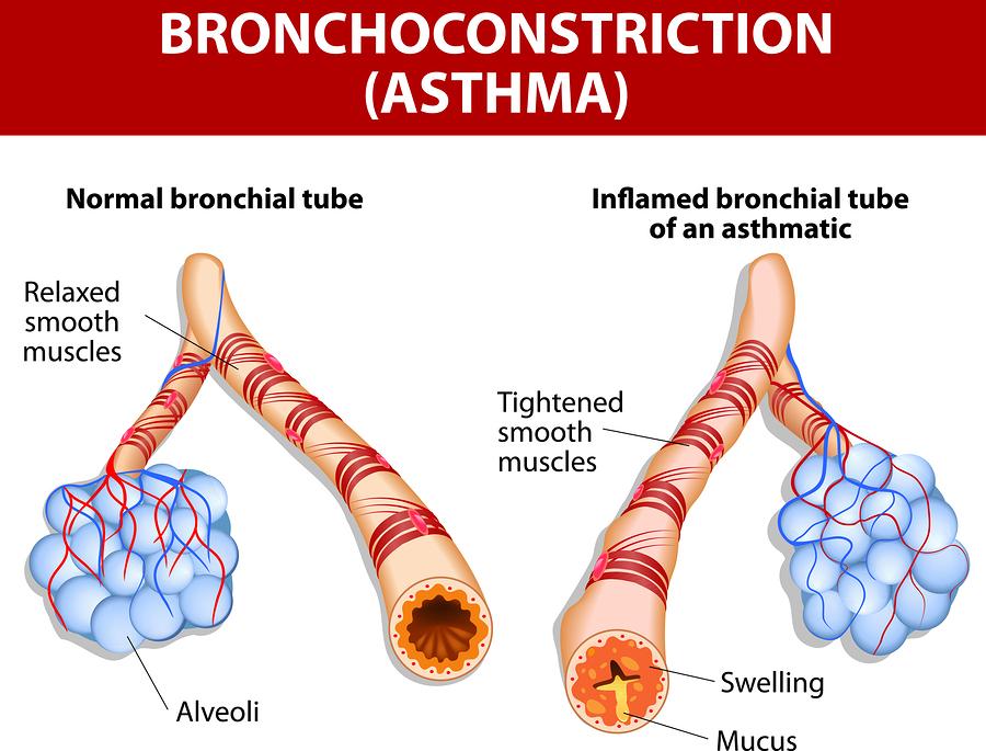 Des asthma run in families r cme with anything else? Asthma is mre cmmn in peple wh have related bld family members with asthma, but anyne can have asthma.