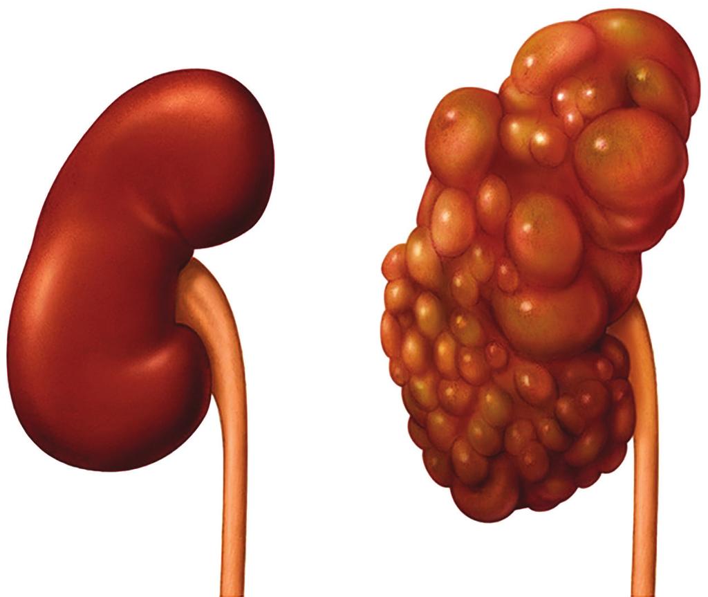 Frontiers in Autosomal Dominant Polycystic Kidney Disease (ADPKD)