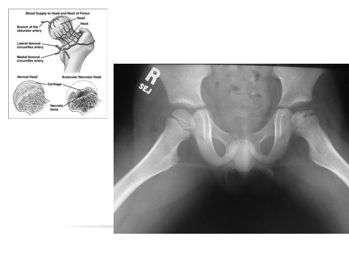 SLIPPED CAPITAL FEMORAL EPIPHYSIS (SCFE) Femoral head slips inferior and posterior to femoral neck Incidence 2/100,000