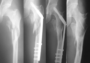 193 Yu-Tun Hsu, et al A B C D Fig. 2 A 46-year-old man sustained a left Ib subtrochanteric fracture due to a motor vehicle accident (A).