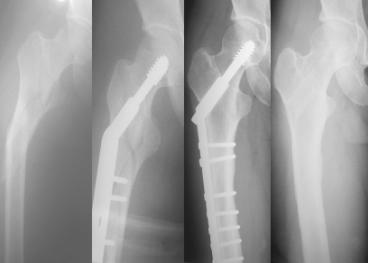 The implant was removed at 1 year (D). A B C D Fig. 3 A 77-year-old woman sustained a right IIb subtrochanteric fracture due to sliding down (A).