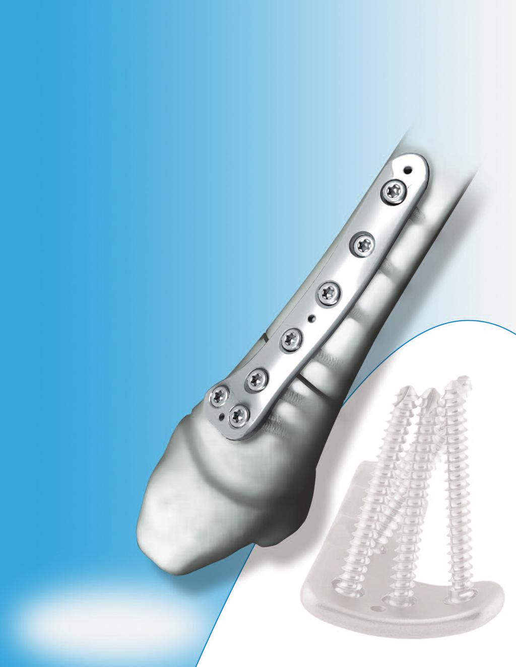 PediLoc T I B I A S U R G I C A L T E C H N I Q U E A New Benchmark in Tibial Fixation Multiple plate designs for more options in osteotomies and