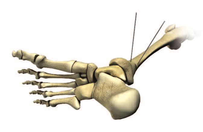 PediLoc Tibia 3 Select one of the plates (narrow medial, wide medial or anterolateral) and
