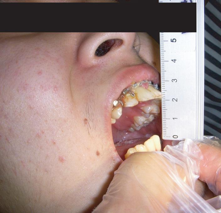 Treatment of extensive comminuted mandibular fracture using a reconstruction plate Fig. 3. At postoperative 6 week follow-up, 23 mm of mouth opening was measured. Fig. 5.