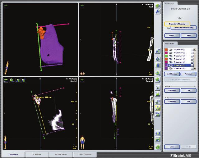 Resorbable osteosynthesis material using SonicWeld system Chapter 17 93 Fig. 10: Measurement of the height of the mandibular ramus Fig.