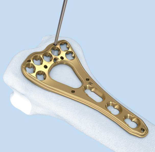 Technique: Surgical steps 2. Reduce fracture and position plate Reduce the fracture. The reduction method will be fracture-specific.