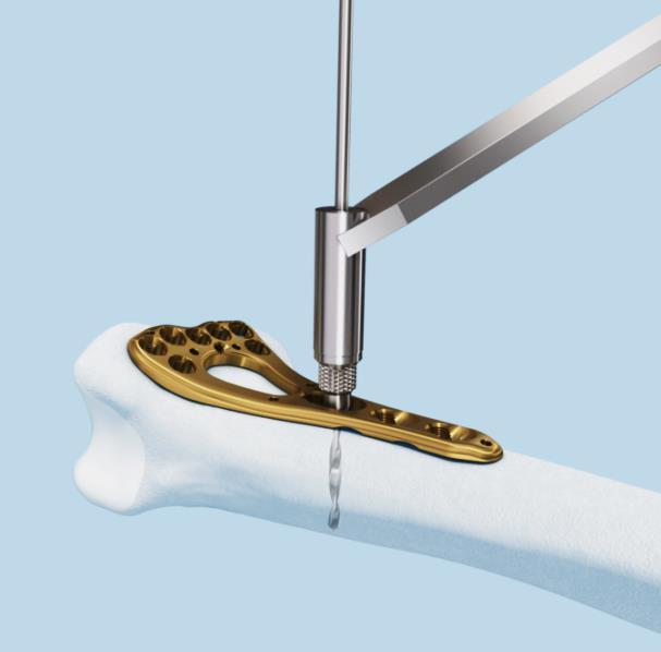 Technique: Surgical steps 3. Drill screw hole for cortex screw Beginning with the elongated hole in the shaft of the plate, drill with the 1.8 mm drill bit using the Universal Drill Guide 2.4 for a 2.