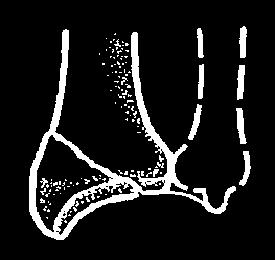 fractures (A2-A3) Partial