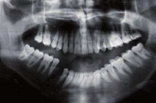 intraoperative fine adjustment of the plate and the lower jaw before the
